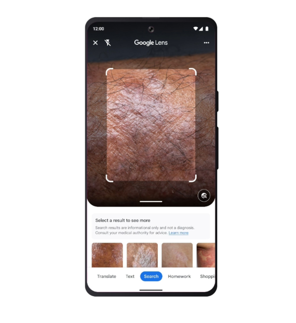 Google Lens Hautanalyse